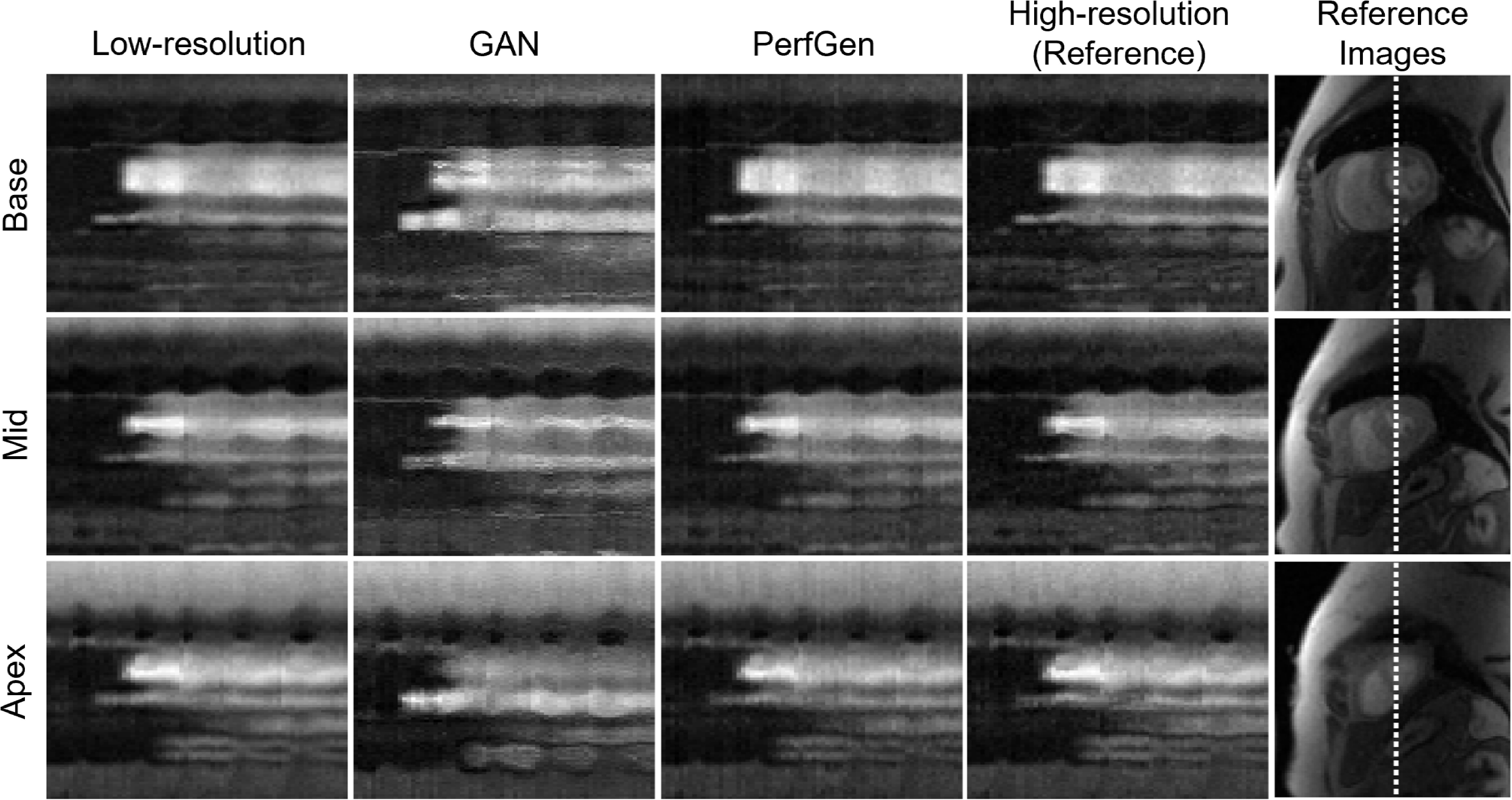 Conditional diffusion-generated super-resolution for myocardial perfusion MRI